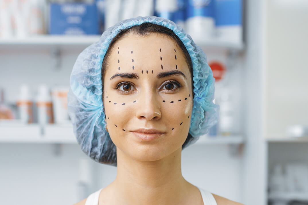 Botox hoito. Silmien väliset rypyt+otsa+silmäku