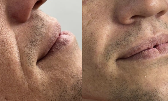 Täyteainehoito nenä–suupieli-juonteiden tasoittamiseen