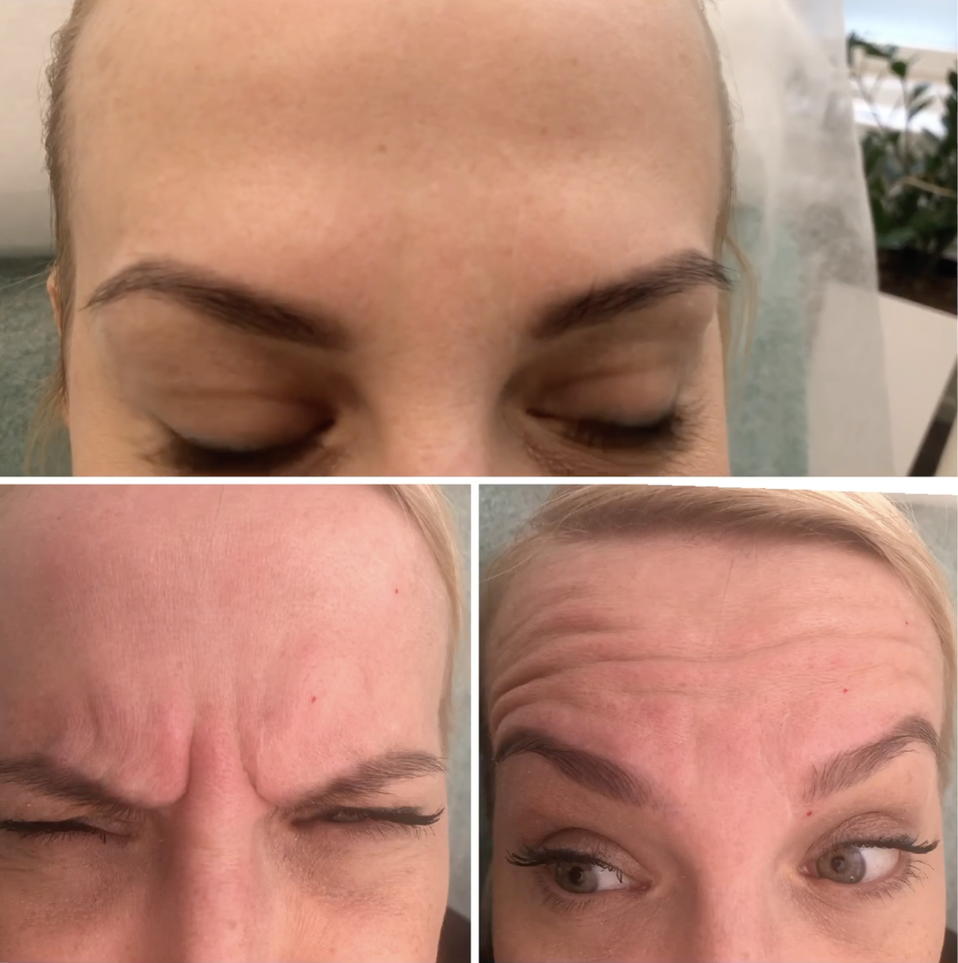 Botuliinihoito otsalle ja kulmien väliin