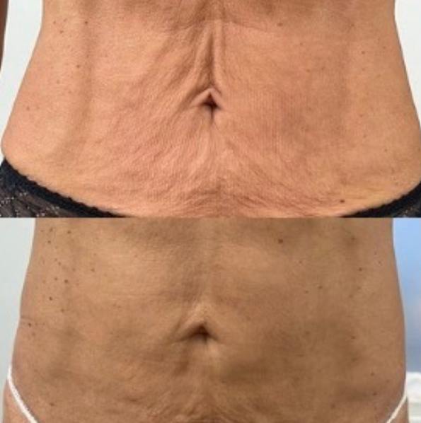 Contour Vartalohoito