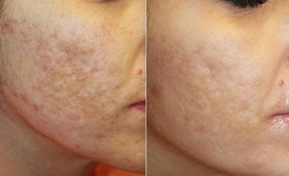 Endymed Intensif RF-Mikroneulaus + FSR