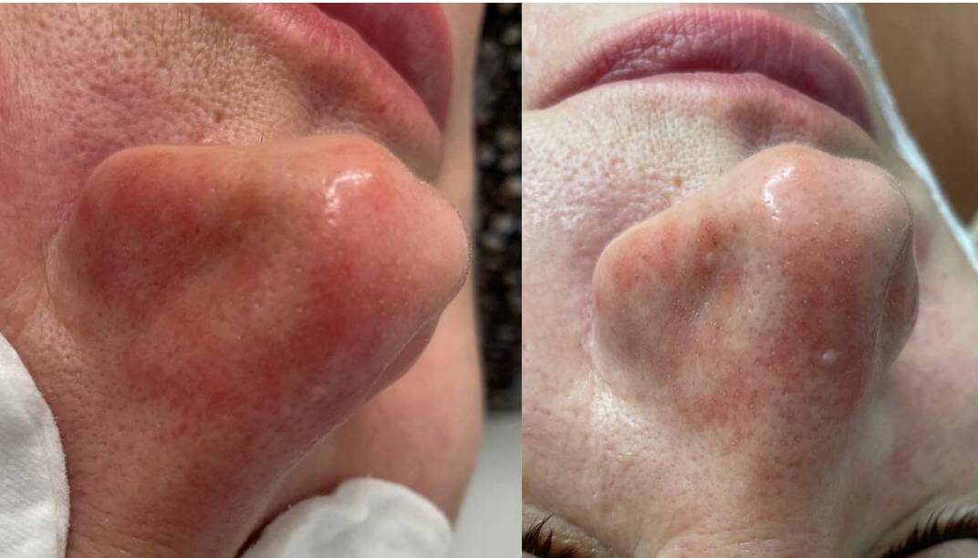 Fotona-laserhoito – couperosan hoito