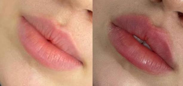 Huulten täyttö ja muotoilu