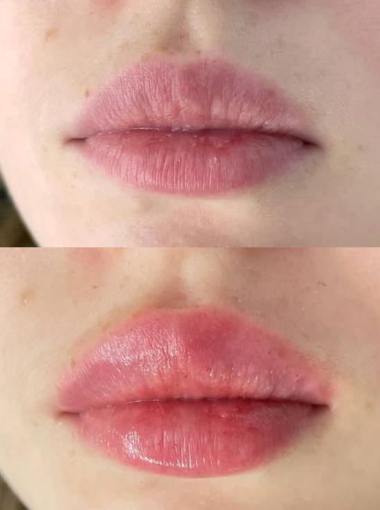 Huulten täyttö ja muotoilu