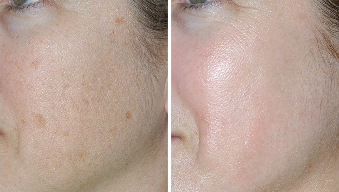 IPL-hoito pigmenttiläiskiin